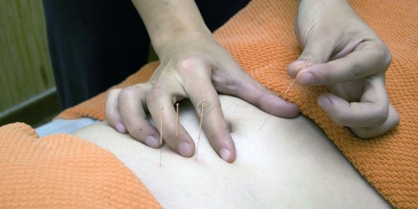 Acupuntura alivia náusea causada por quimioterapia